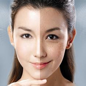 女性如何祛斑