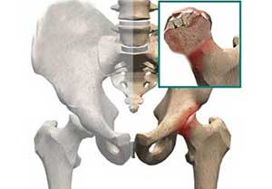 股骨头坏死的原因