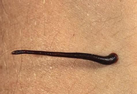 蚂蟥咬伤的急救