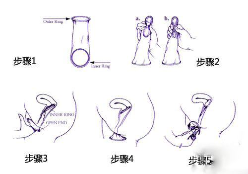 详解女用避孕套使用方法(图解)