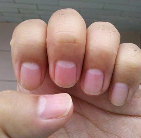 手指甲上没有月牙怎么办 增强体质是关键