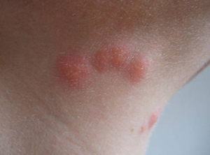 被臭虫咬了怎么办