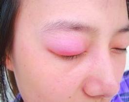 水肿吃什么 水肿能吃什么东西