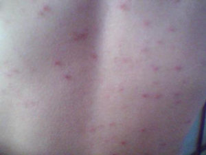 身上起小红疙瘩很痒