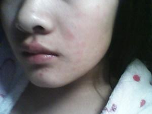 过敏性荨麻疹不能吃什么 过敏性荨麻疹注意