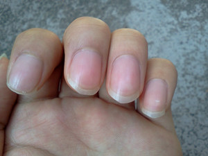 指甲上有竖纹怎么办 如何治疗