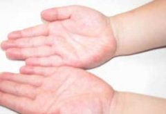 ������Ƥ�Ĵ����취 ������Ƥ��ԭ��