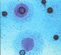 ����֧ԭ���Ⱦ֢״ ������ʹ����