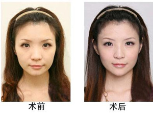 美白针前后对比明显吗 美白针效果对比图